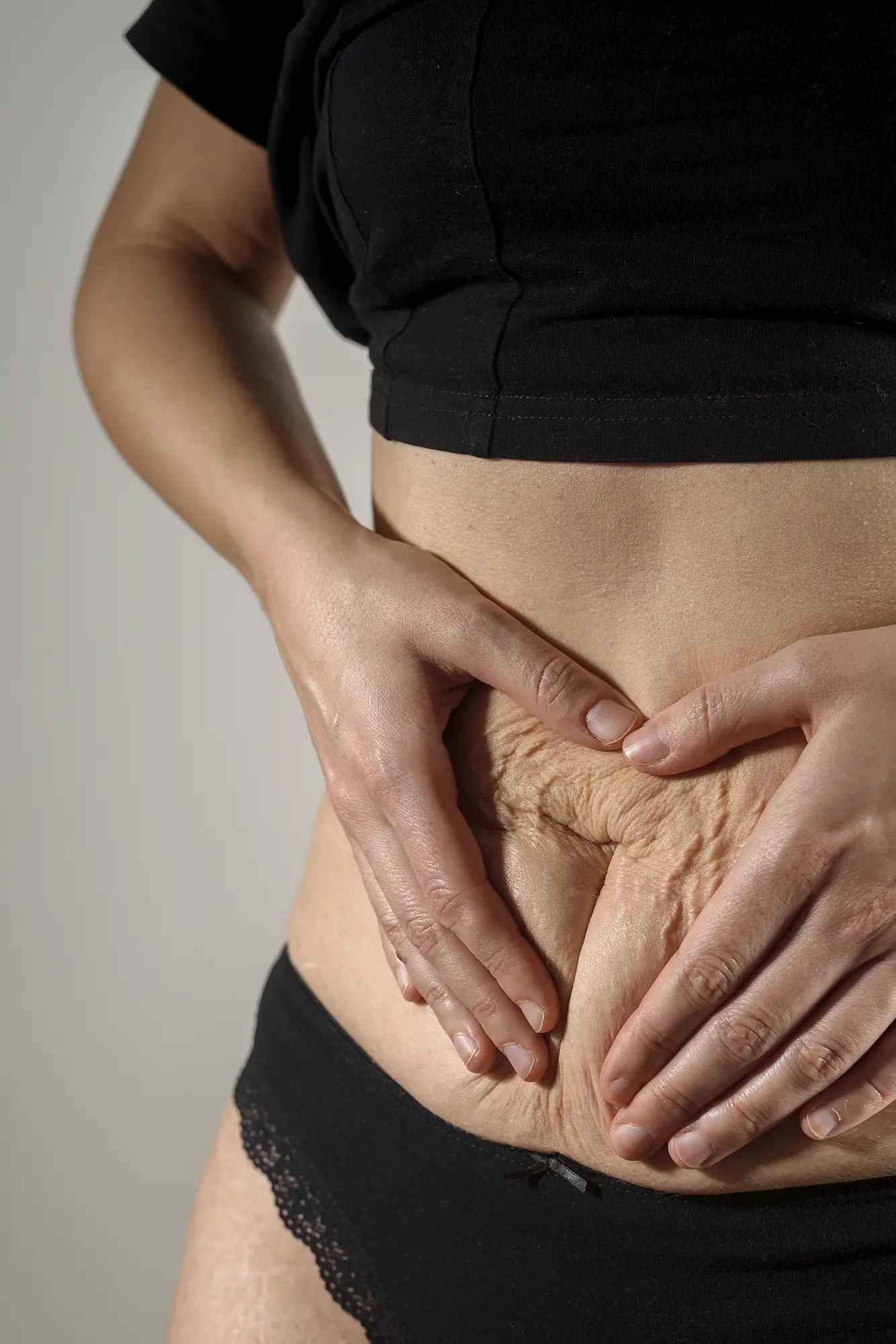 Définition abdominoplastie - CEBC