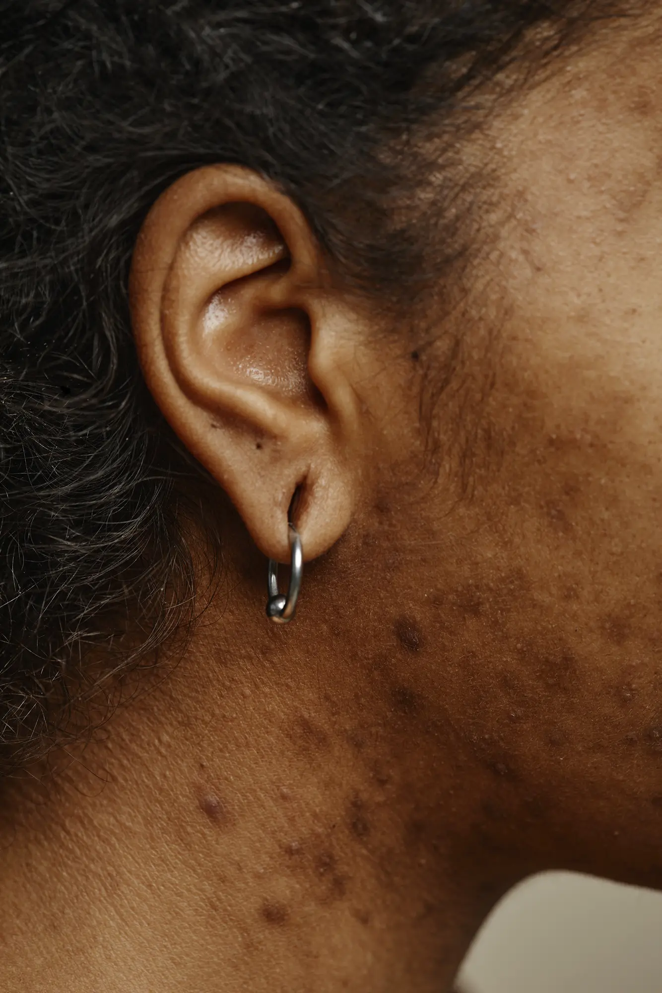 Définitions des lobes fendus | CEBC Bordeaux