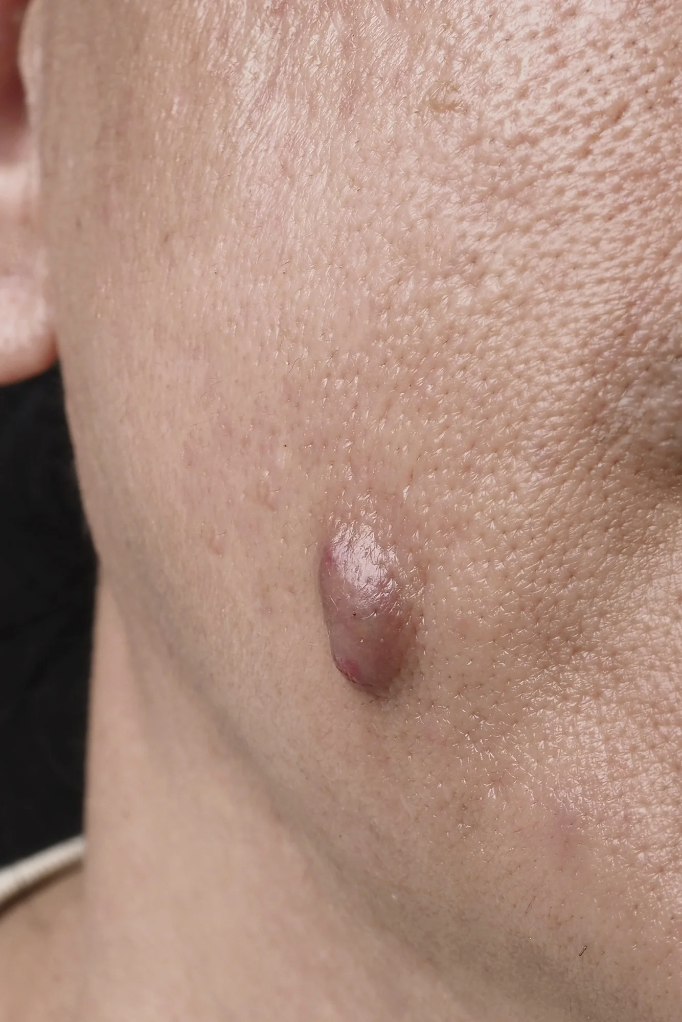 Retirer une lésions cutanées | CEBC